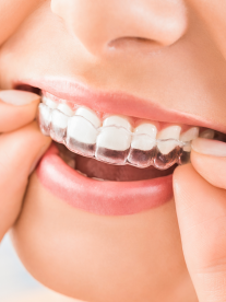 A person wearing an Invisiline retainer.